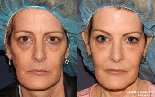 Facial harmonization with filler + BTX