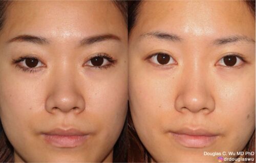 Natural nose bridge enhancement