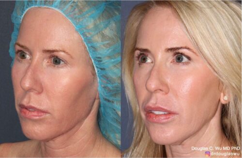 Customized maintenance treatment plan (10 years later)