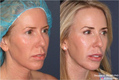 Customized maintenance treatment plan (10 years later)