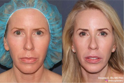 Customized maintenance treatment plan (10 years later)