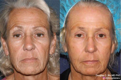 Customized maintenance treatment plan (10 years later)