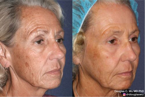 Customized maintenance treatment plan (10 years later)