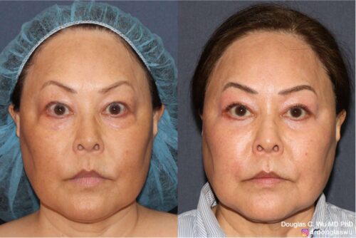 Customized maintenance treatment plan (10 years later)