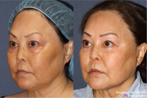 Customized maintenance treatment plan (10 years later)