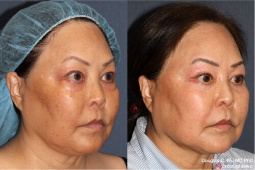 Customized maintenance treatment plan (10 years later)