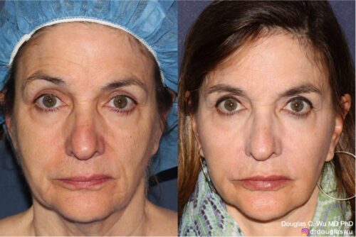 Customized maintenance treatment plan (5 years later)