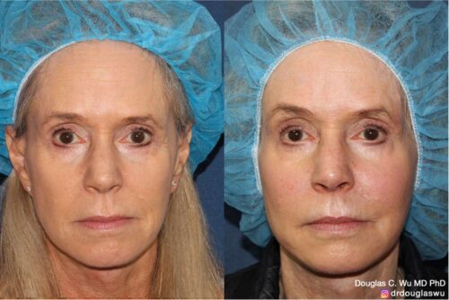 Customized maintenance treatment plan (10 years later)