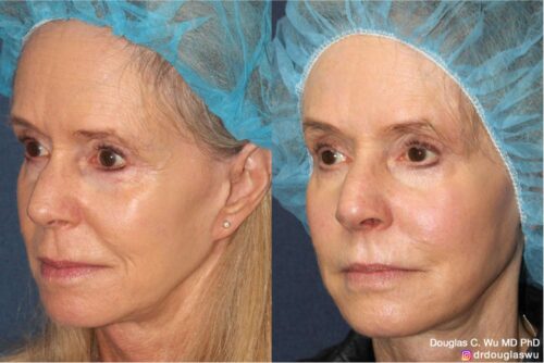 Customized maintenance treatment plan (10 years later)