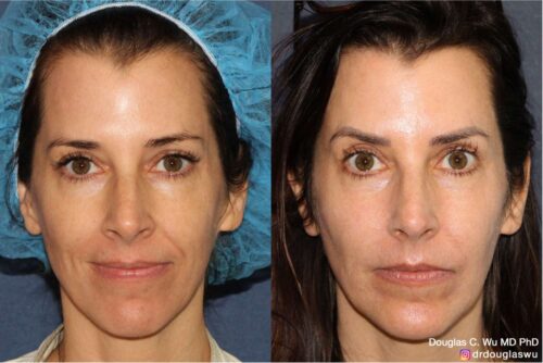 Customized maintenance treatment plan (5 years later)