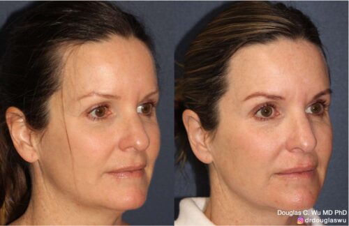 Customized maintenance treatment plan (5 years later)