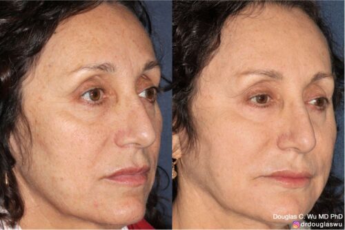 Customized maintenance treatment plan (10 years later)