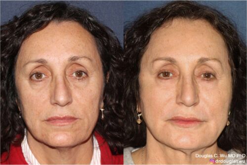 Customized maintenance treatment plan (10 years later)