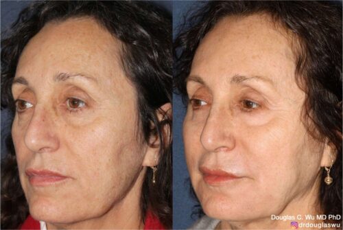 Customized maintenance treatment plan (10 years later)