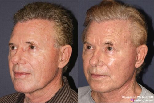 Customized maintenance treatment plan (10 years later)