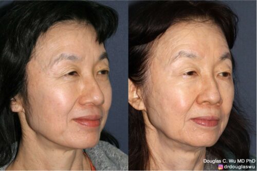 Customized maintenance treatment plan (10 years later)