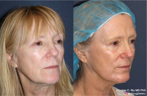 Customized maintenance treatment plan (10 years later)