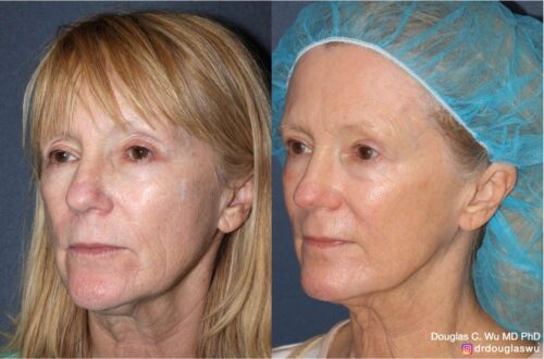 Customized maintenance treatment plan (10 years later)