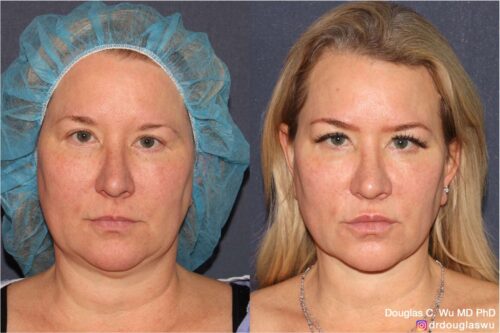 Multimodal combination treatment (Pico, Vbeam, IPL, CO2, Thermi, BTX, Filler)