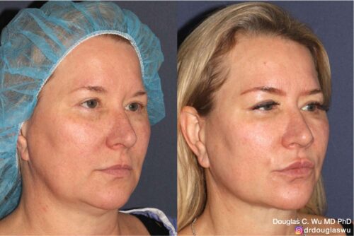 Multimodal combination treatment (Pico, Vbeam, IPL, CO2, Thermi, BTX, Filler)