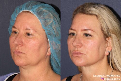 Multimodal combination treatment (Pico, Vbeam, IPL, CO2, Thermi, BTX, Filler)