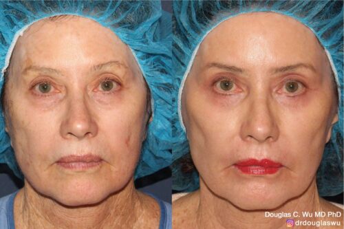 Multimodal combination treatment (CO2, ErYAG, Pico, Vbeam, Ulthera, BTX, Filler)