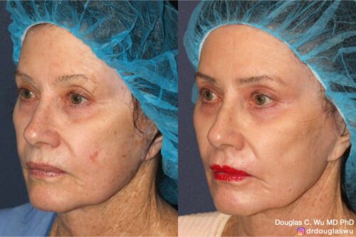 Multimodal combination treatment (CO2, ErYAG, Pico, Vbeam, Ulthera, BTX, Filler)