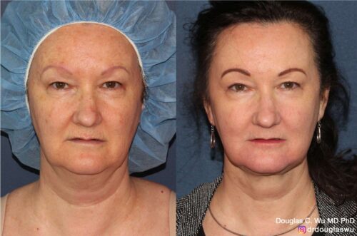 Multimodal combination treatment (CO2, ErYAG, Pico, Vbeam, Thermi, BTX)