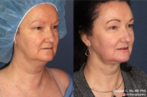 Multimodal combination treatment (CO2, ErYAG, Pico, Vbeam, Thermi, BTX)