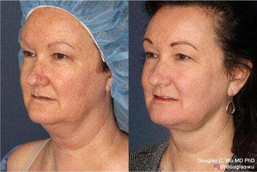 Multimodal combination treatment (CO2, ErYAG, Pico, Vbeam, Thermi, BTX)