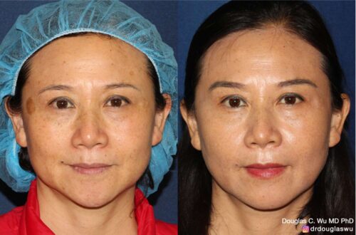 Multimodal combination treatment (Pico, Frax, BTX, Filler)