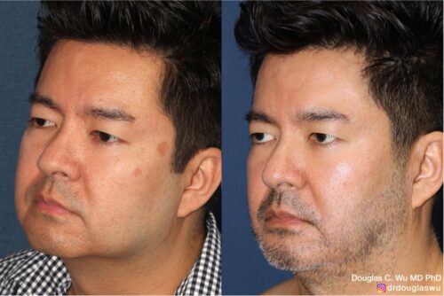 Multimodal combination treatment (Pico, Frax)