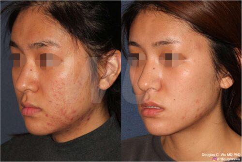 Acne and acne scar treatment