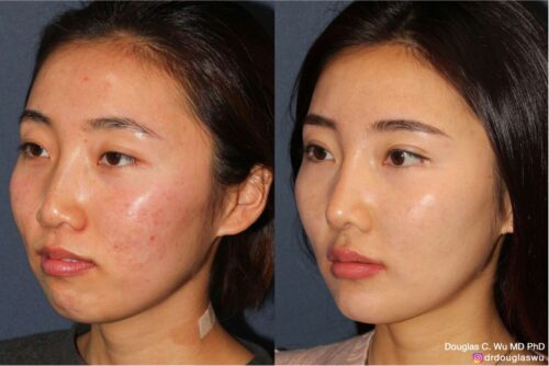 Multimodal combination treatment (RFM, Frax, Vbeam, BTX, Filler, PDT)