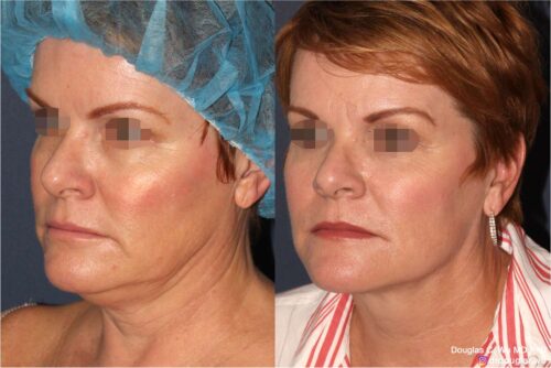 ThermiSculpt to neck and jawline