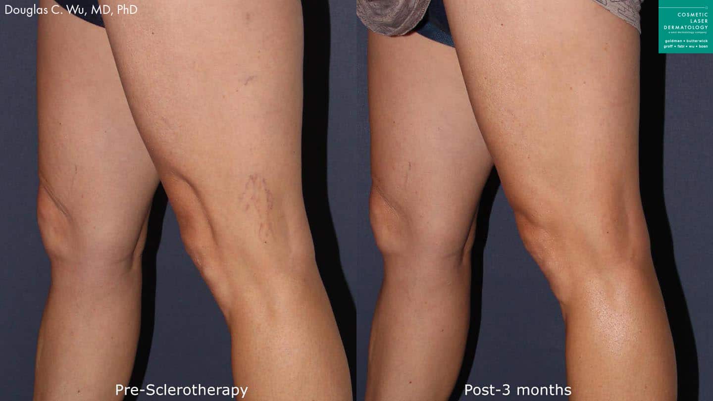 Before and after photos of Sclerotherapy for leg veins