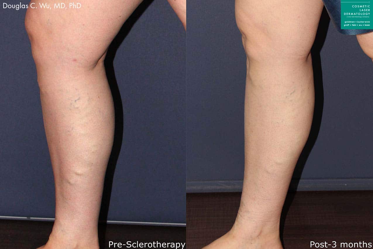 Before and after photos of Sclerotherapy for leg veins