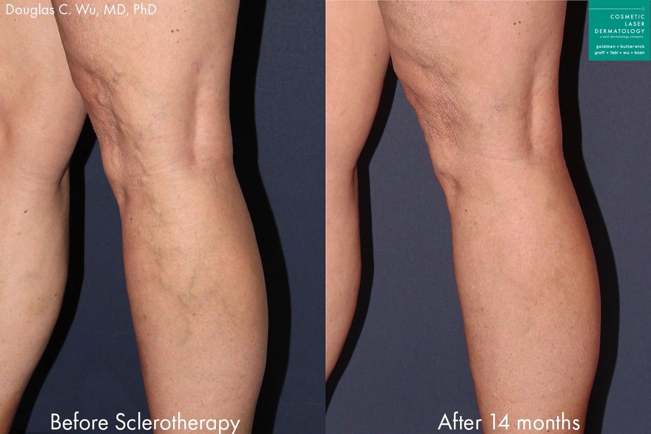 Before and after photos of Sclerotherapy for leg veins