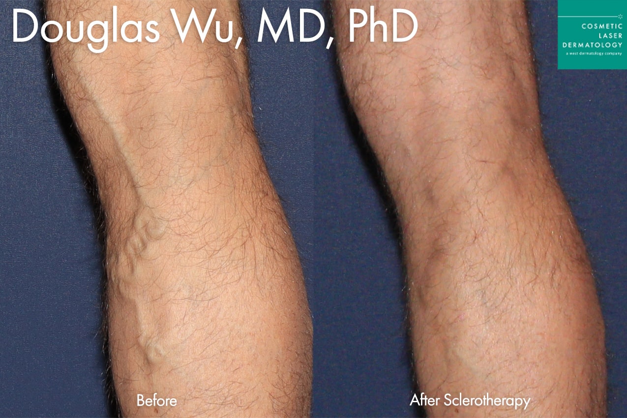 Before and after photos of Sclerotherapy to treat varicose veins