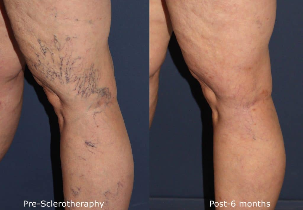 Before and after photos of Spider Vein Removal (Sclerotherapy)