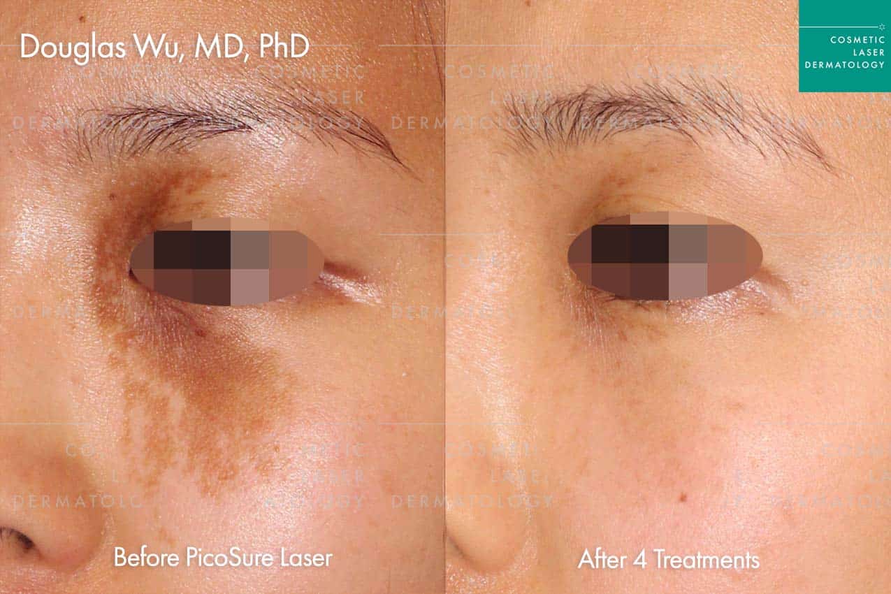 Picosure Laser Birthmark removal before and after photos performed by Dr. Douglas Wu