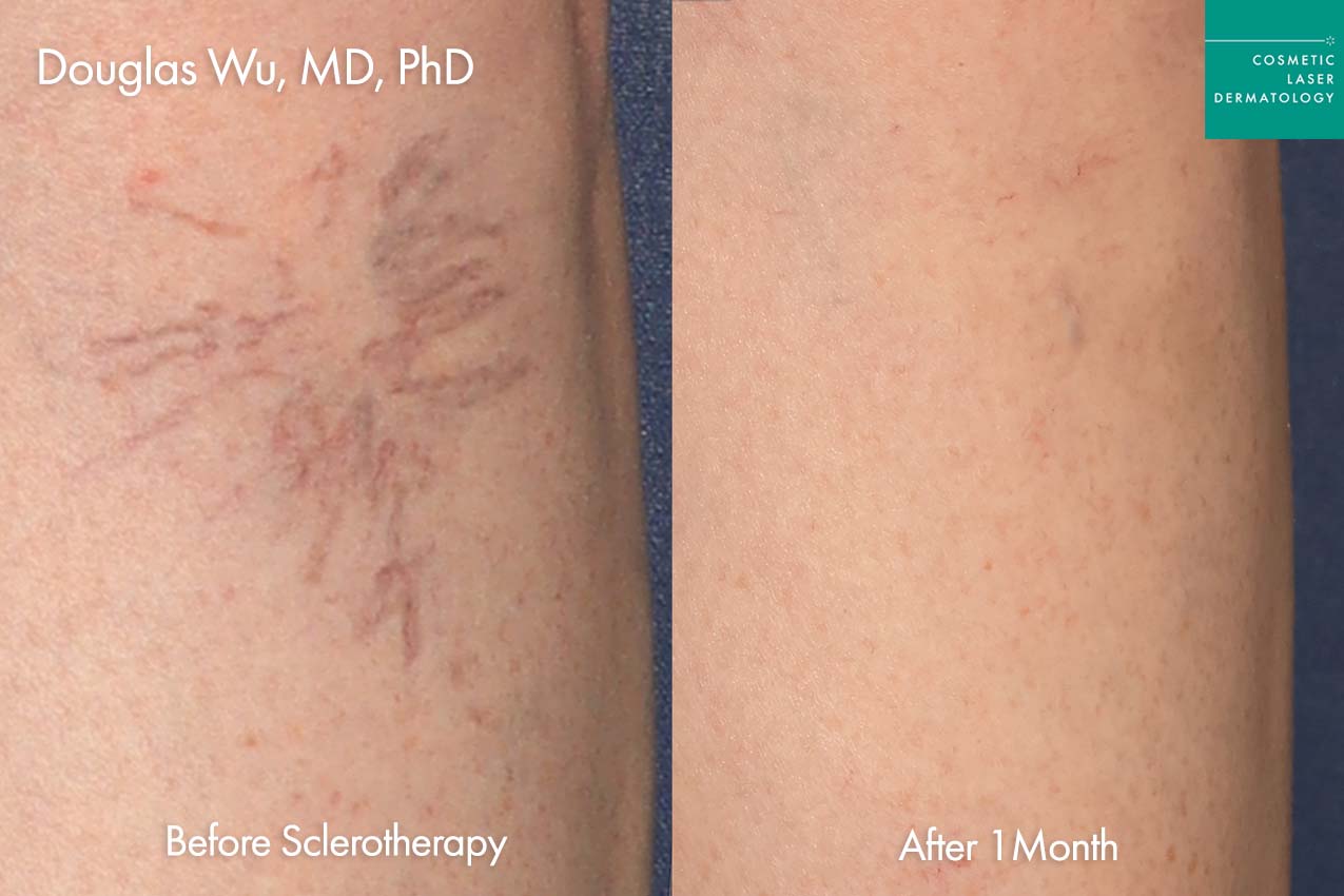 Sclerotherapy before and after photos