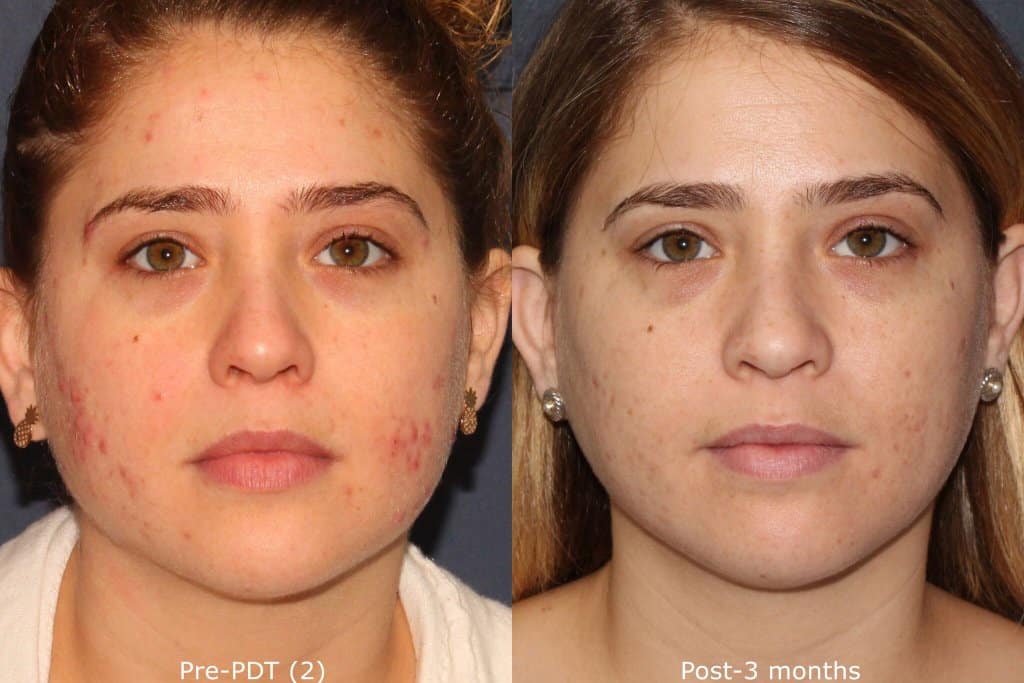 Photodynamic therapy before and after photos of a female patient in Vancouver