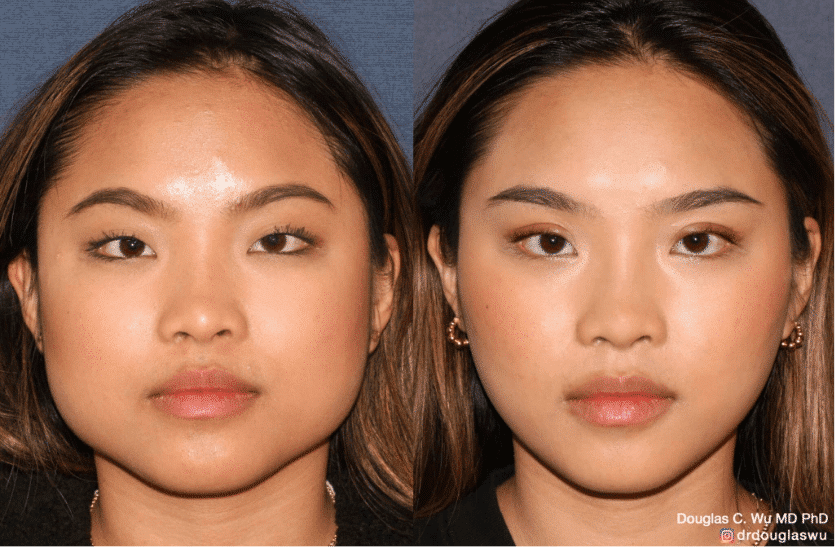 Facial Sculpting with Injectables